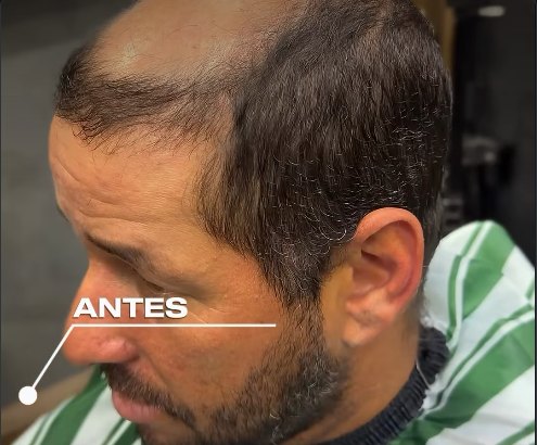 Cliente com calvície no topo da cabeça, antes da prótese